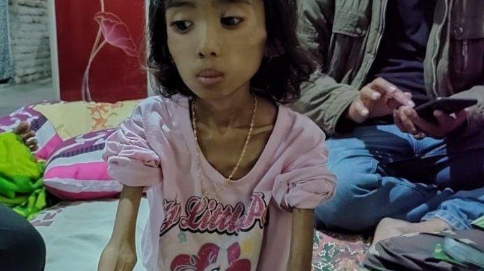 Fakta Gizi Buruk Masih Ditemukan di Banyak Daerah