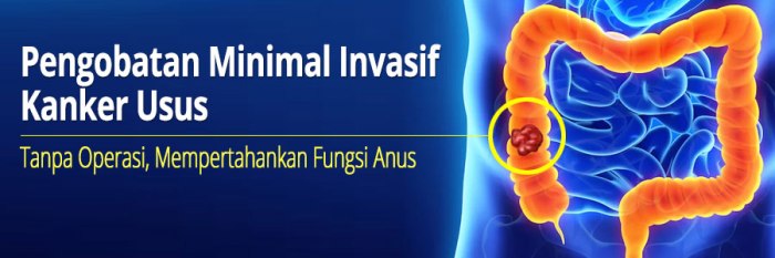 Mpok Atiek Ngeluh Sakit Terus, Ternyata Ada Tumor di Usus - Akurat Bertahun-tahun Sakit Perut, Ternyata Ada Tumor Jinak di Usus