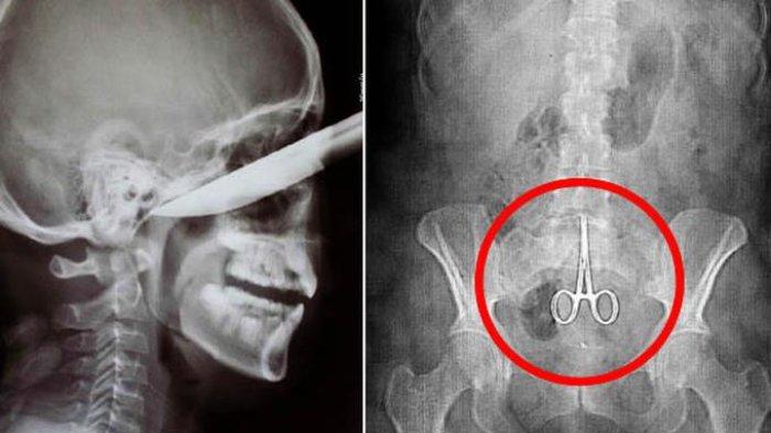 Bertahun-tahun Sakit Perut, Ternyata Ada Tumor Jinak di Usus